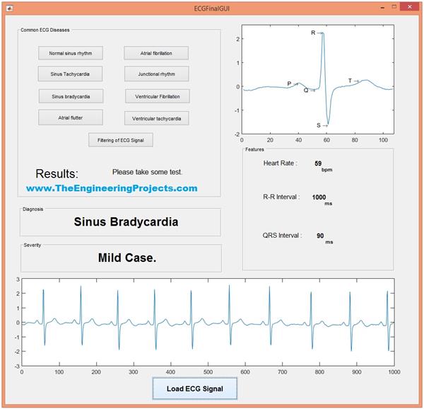 ECG Simulation Using MATLAB - The Engineering Projects