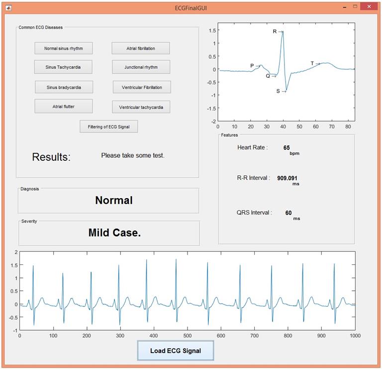 ECG Simulation Using MATLAB - The Engineering Projects