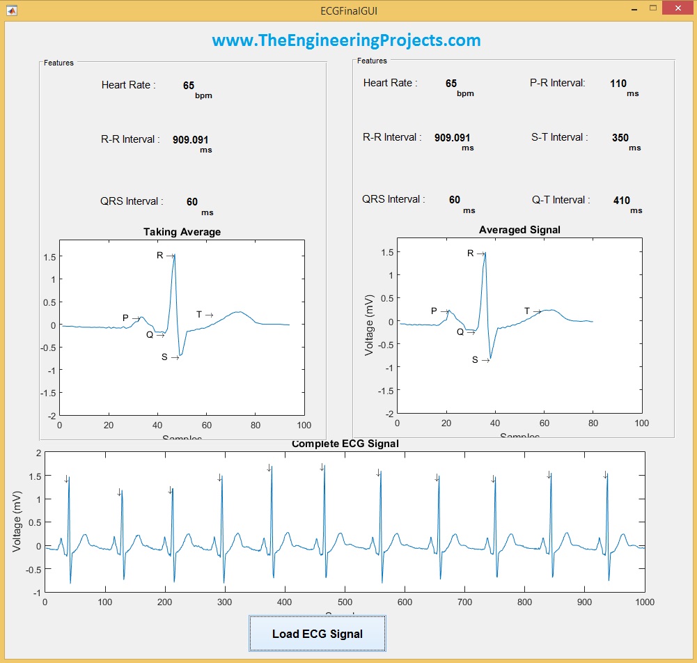 ECG Averaging in MATLAB, ECG Average,average ecg,ecg averaging